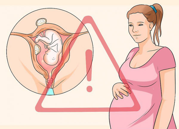 Bệnh u xơ tử cung có thể ảnh hưởng đến sự phát triển của bé trong giai đoạn mang thai 